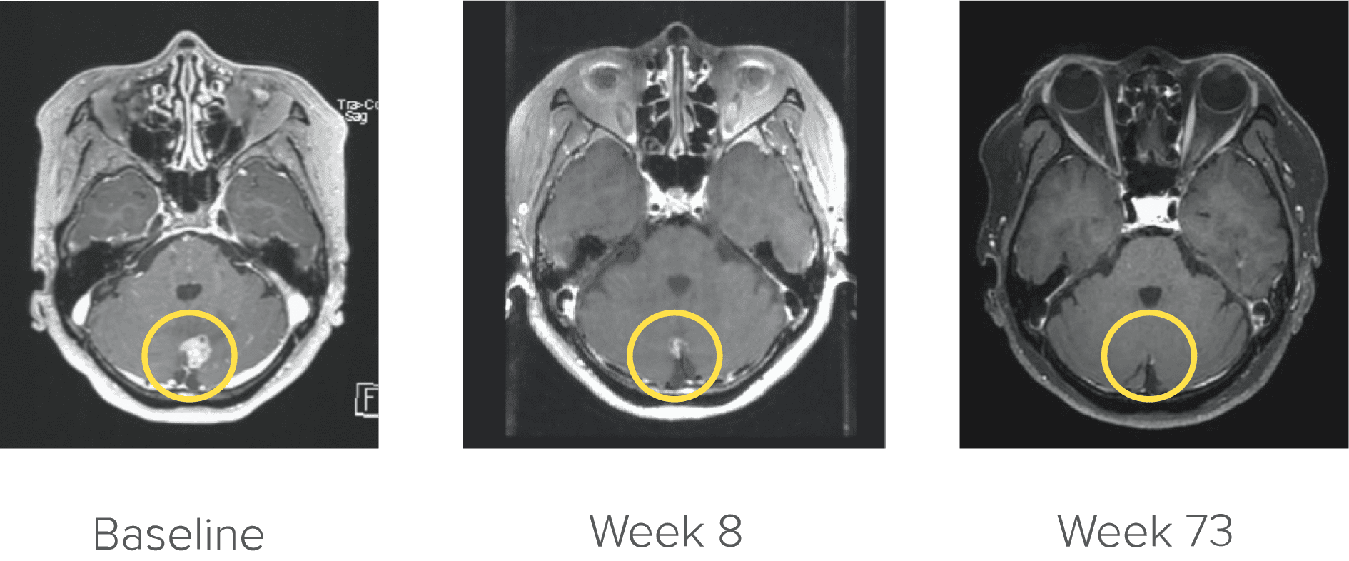 Brain scans of RET+ mNSCLC patient at baseline, week 8, and week 73